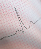 Das Arzneimittel Azithromycin kann wohl Herzrhythmusstörungen begünstigen